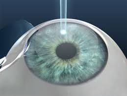 Transplante de Olhos